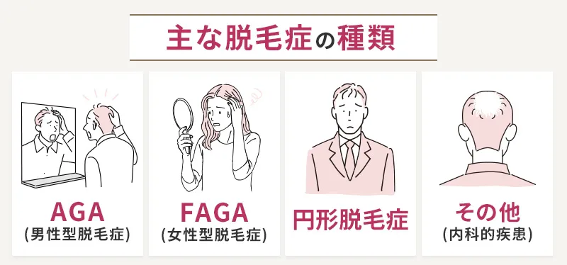 脱毛症の種類