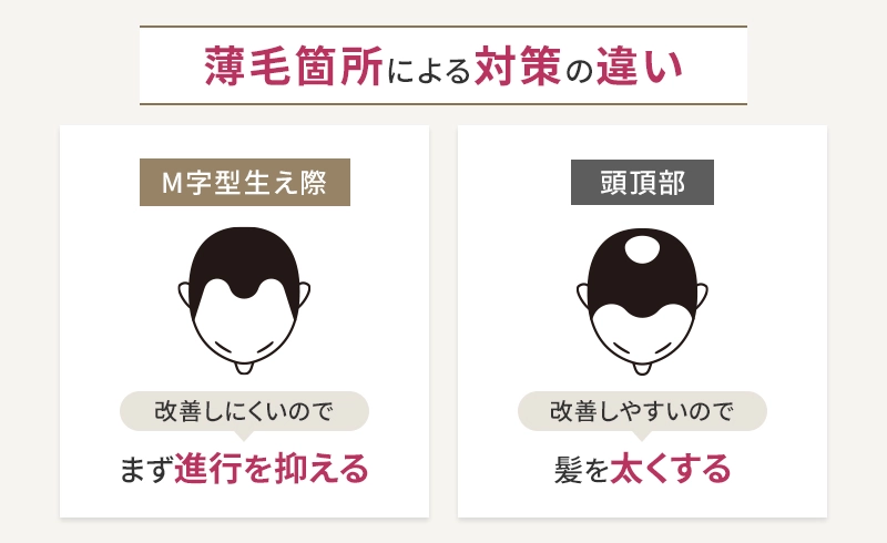 AGAの発症個所による対策の違い