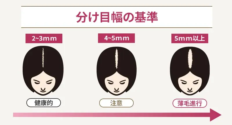 分け目ハゲの基準